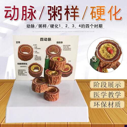血管/堵塞动支脉粥样/硬化心血管动脉/硬L化模型血管病理模型血栓