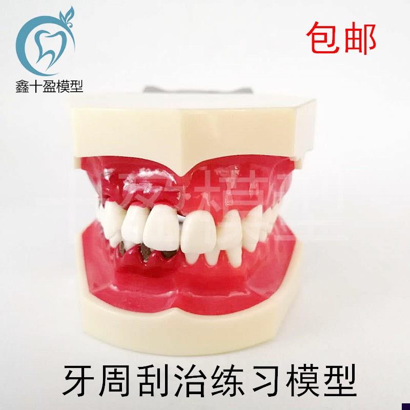 牙科牙结石d刮治练习龈下去除模型牙周病理模型医患教学教具4025