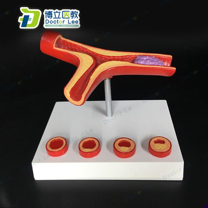 血管堵4塞血液浓度脂肪病理血液血管粥样血管X病理解剖模型