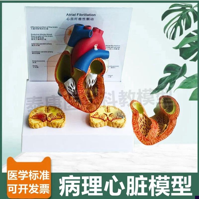 病理心脏模型颤动心房临床医患沟通人体心脏解剖S瓣膜冠状动脉心
