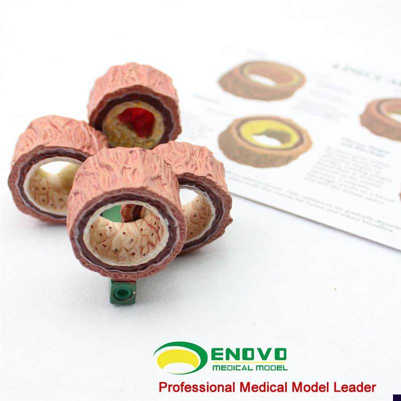 颐诺正品动脉f粥样硬化模型血栓病变模型心血管模型内科学
