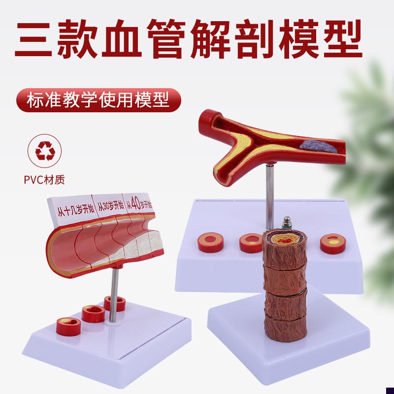 4阶段硬化动脉病理血管u模型病冠心人体病态血管血管解剖模型