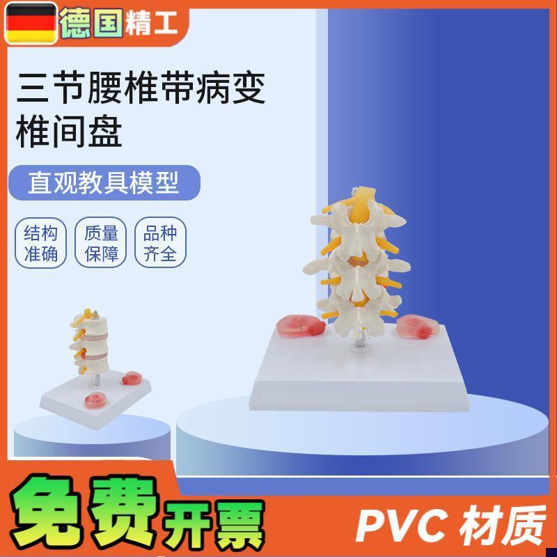 德国】PNT0131三节腰椎带病变椎F间盘病变椎间盘骨骼模型骨科疼痛