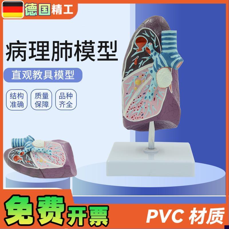 德国人体病理肺模型m仿真吸烟者肺部内脏器官标本胸外科呼吸科教