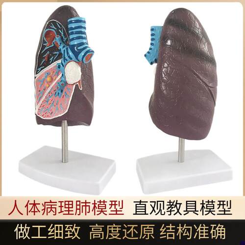 人体病理肺解剖病变o肺模型吸烟者内脏病态肺部切面呼吸系统模型