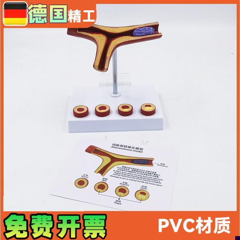 德国】动脉模型血栓冠心血管解剖教学医药礼品健康W管理教具医学