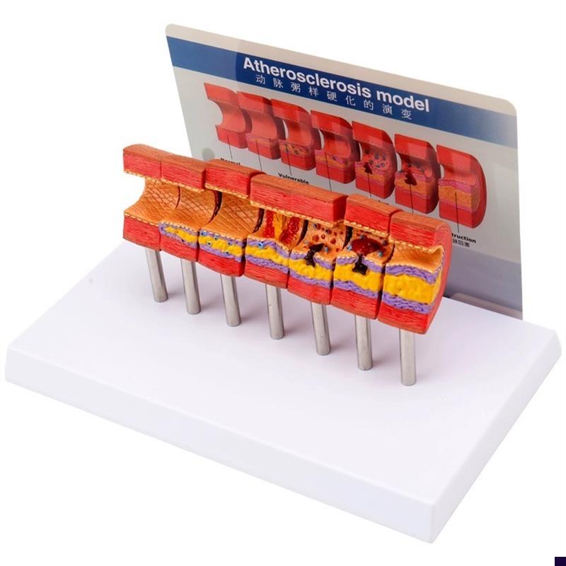 心脑血管堵塞g动支脉粥样硬化血栓血液浓度脂肪病理教学用模型道
