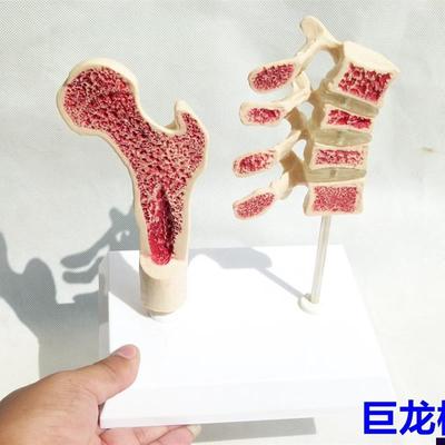 医学教学骨科人体骨质疏s松健康与病态比较模型人骨人体模型教具