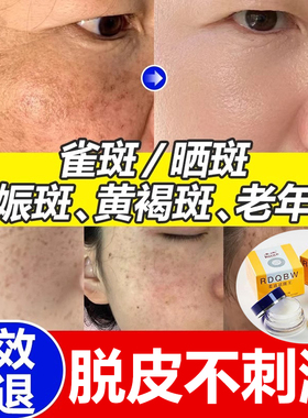 柔迪祛斑王正品官方旗舰店淡化色斑美白祛斑霜膏祛黄褐雀斑会脱皮