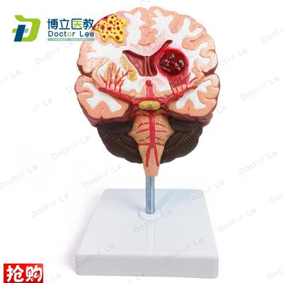 人体脑解剖脑病理疾病脑病A理构造脑(血管)病变脑模型