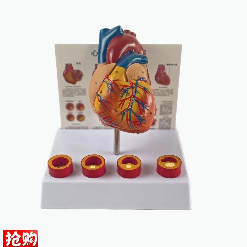 康泰模型心血管粥样硬化狭窄阻塞病理冠状动脉临床医药Y促销人体