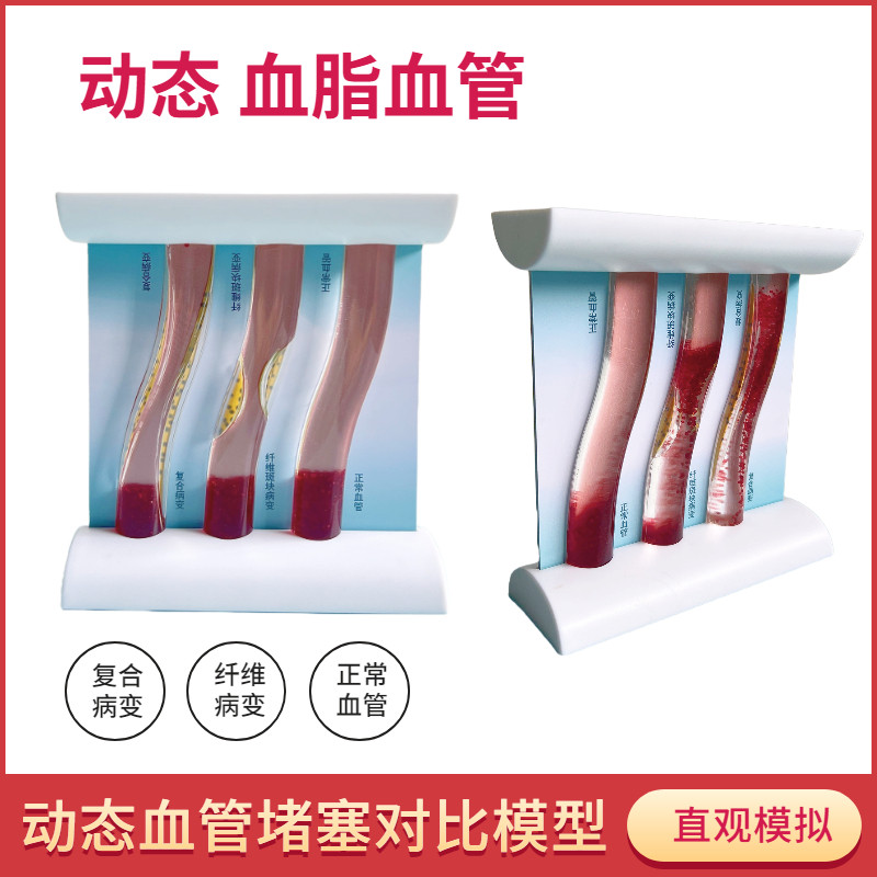 仿真动态高血i脂堵塞对比模型病理血管血脂血栓直观教学模型