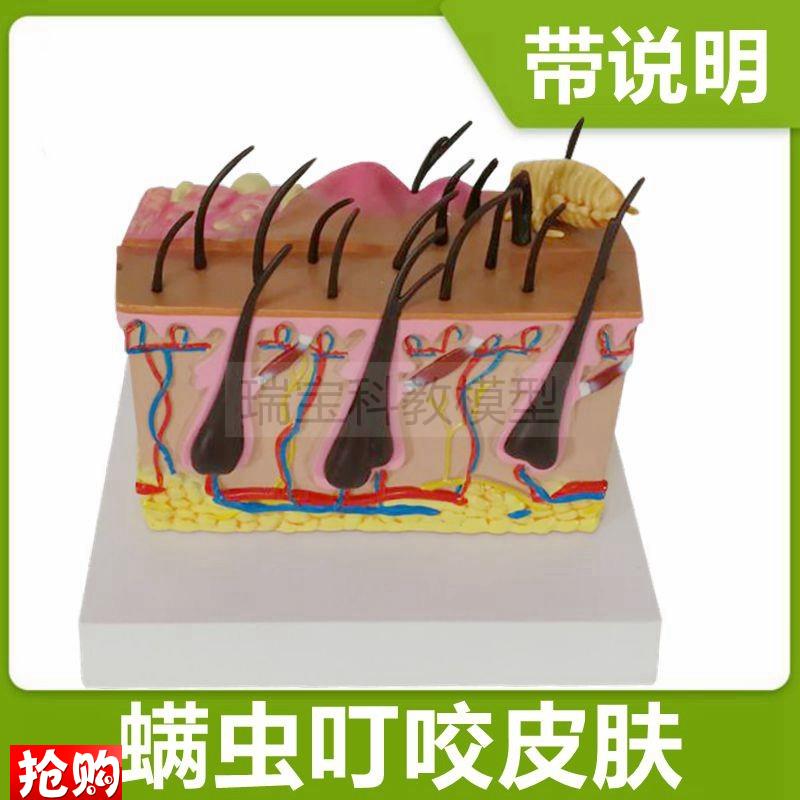 皮肤模型病理蚊虫叮咬过程皮下病变医美微整形皮肤美W容带说明礼