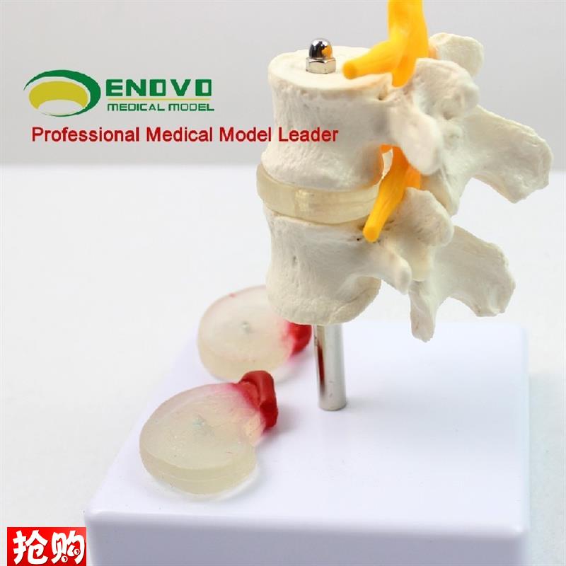 ENOVO颐诺人j体腰椎椎间盘突出模型骨骼脊柱脊椎骨科模型骨科科中