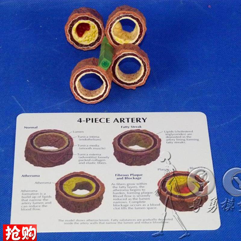 人体血管模型血栓模型血x管硬化血管梗塞病态血管人体模型