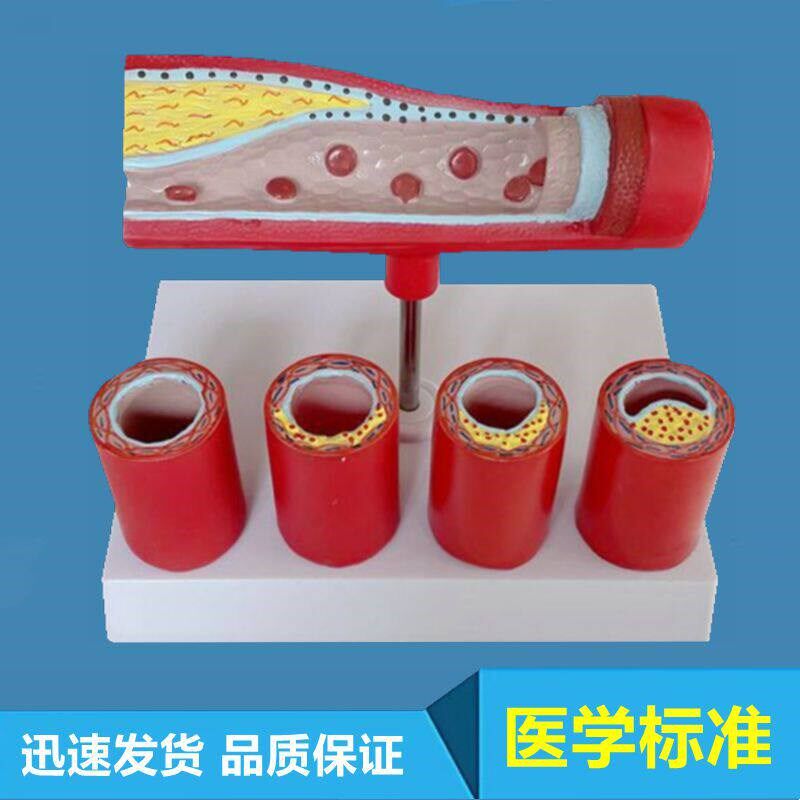 动脉血管模型内膜脂肪斑块血栓阻塞心血I管狭窄年龄段血管达标医