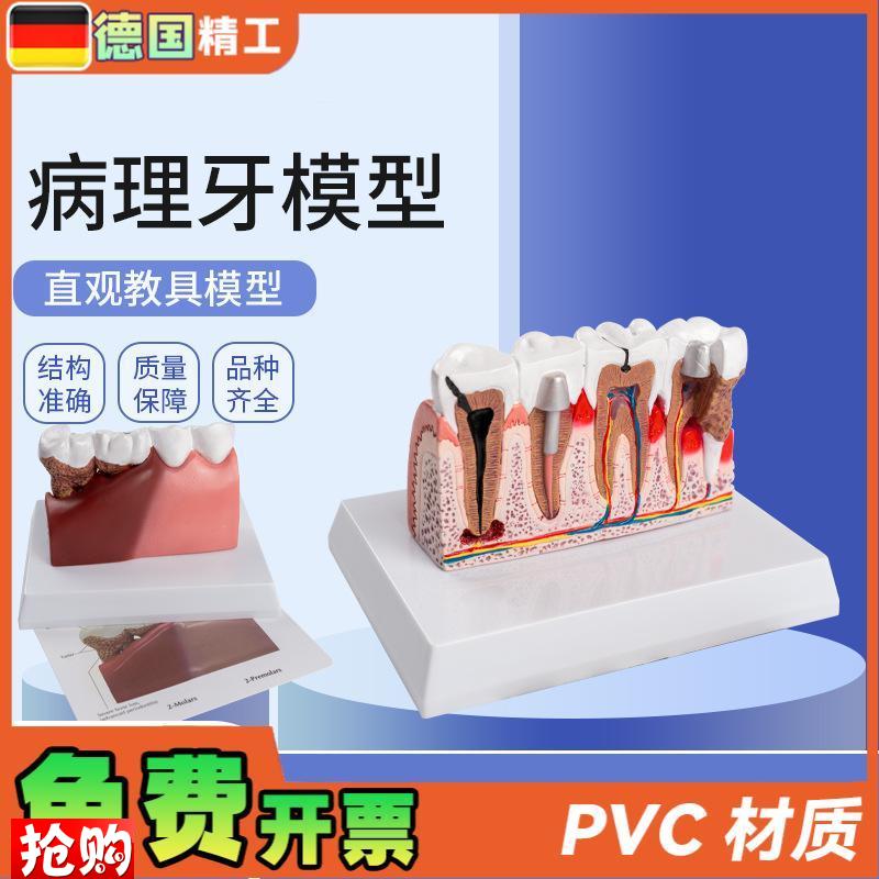 德国】病理牙模型成人病理牙z齿模型口腔模型牙科教学模型演示模