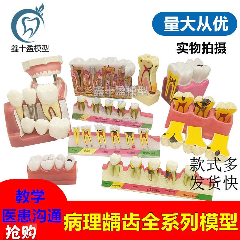 牙科病理模型综合病理种植与修复牙周分类龋Q齿演示蛀牙备牙模型