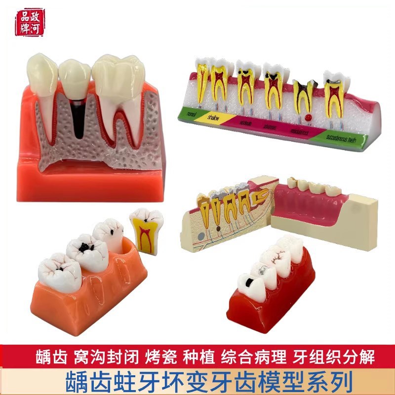 牙齿模型坏牙科种植六倍大龋齿病理修复正M畸假牙口腔医院教学摆