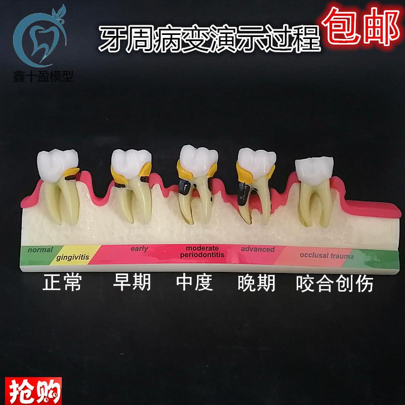 牙齿牙科牙模牙周分o类模型牙周并变重的过程牙科医患沟通展示模