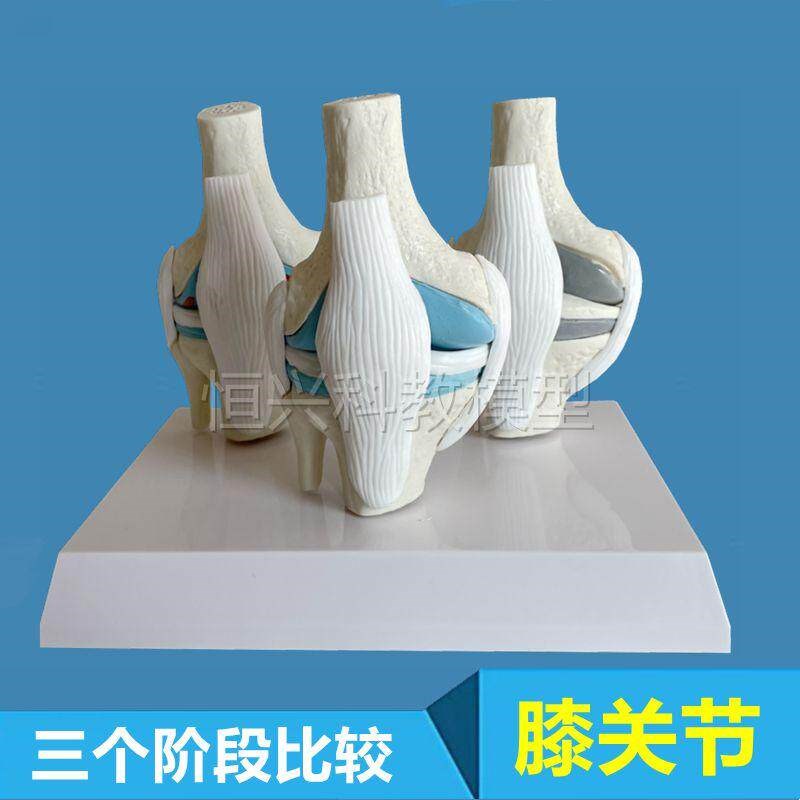 膝关节软骨半月板更换膝盖骨质病理医患医M药促销骨科医用教学人