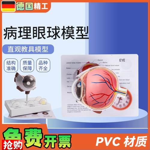 德国】病理眼球模型眼球模型角膜病变眼M球模型医学教学教材模