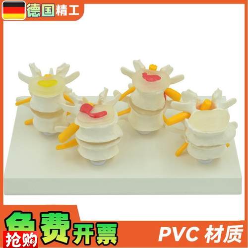 德国】4阶段病变腰椎模型z人体骨骼解剖椎体医学教学器材