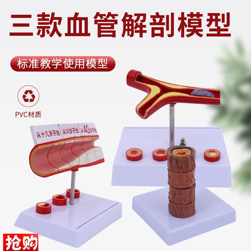 4阶段硬化动脉病理血管模型病冠心人体病态血管血.管解剖模型