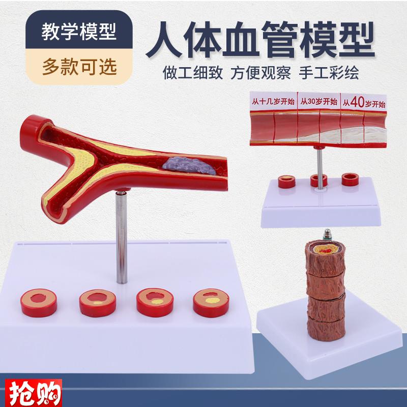 血管解剖模d型动脉粥样化病理心血管血液循环血栓教学模型