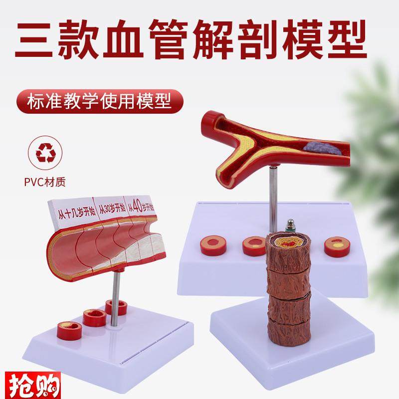 4阶段硬化d动脉病理血管模型病冠心人体病态血管血管解剖模型