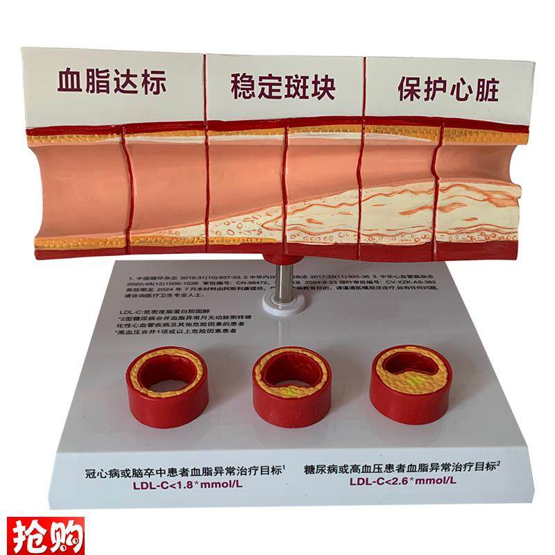 人体血管斑块狭j窄粥样硬化心血管动脉硬化模型血栓人体教学