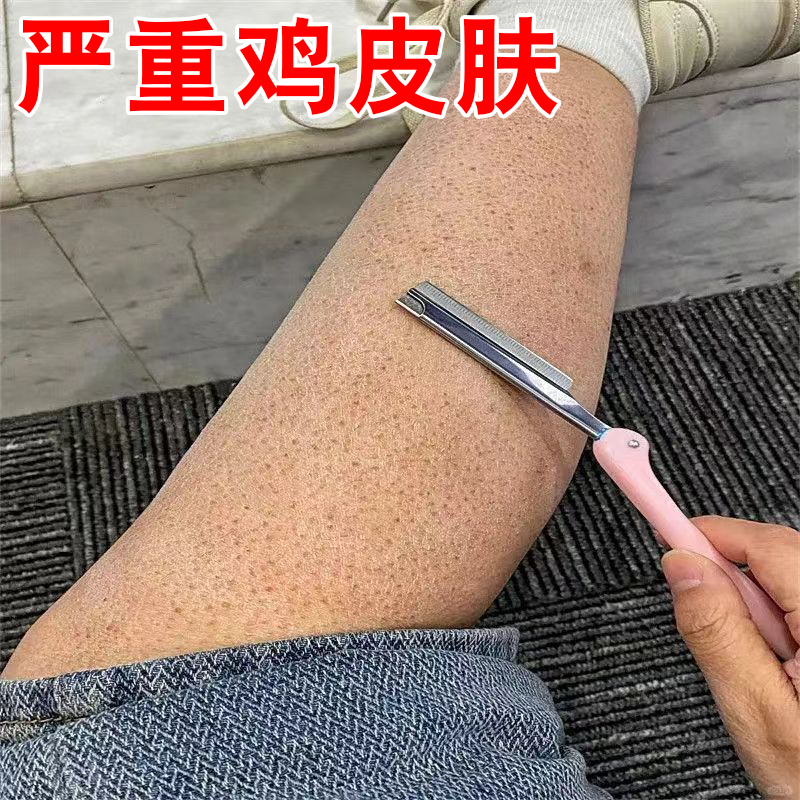 鸡皮肤疙瘩毛囊角化症专用药膏去除胳膊手臂大腿毛囊炎堵塞神器