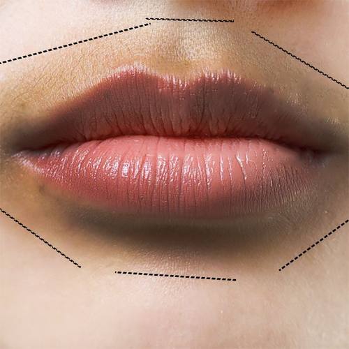 嘴角发黑去除改善唇周黑嘴唇去唇角边黑去黑色素去唇暗沉淡化唇色