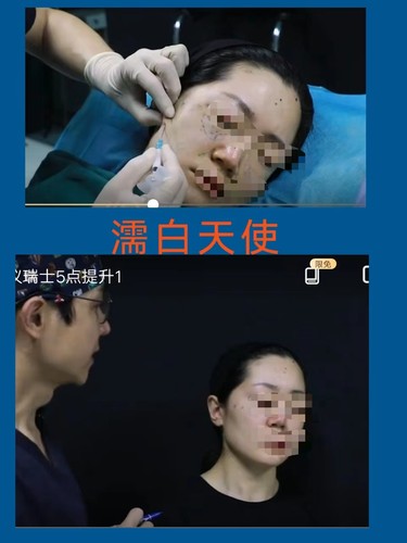 濡白天使面部填充下颌缘瑞士5点提升高清学习3节教程