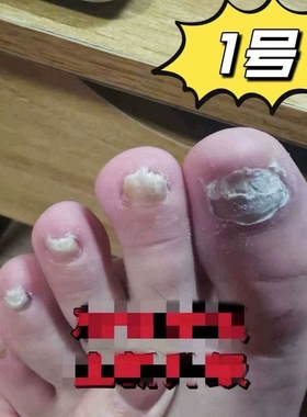 灰 1 空甲厚甲分层萎缩变色浑浊凹凸竖纹甲发黑发黄变脆