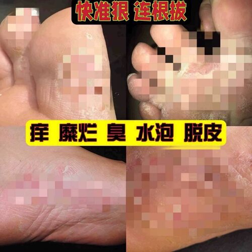 脚 汽 水 泡