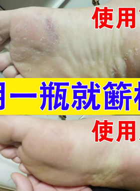 全净美脚气止痒脱皮喷雾专用去烂脚丫缝膏糜烂除真菌感染偏方