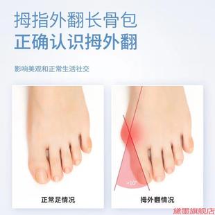 矫形器平衡脚环XO型腿足部指套脚趾矫正器外翻变形网红小腿双环