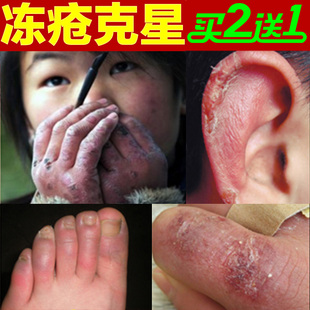 冻疮膏防冻止痒消肿皲裂手部足脚后跟干裂日本药冻疮膏一抹消神器