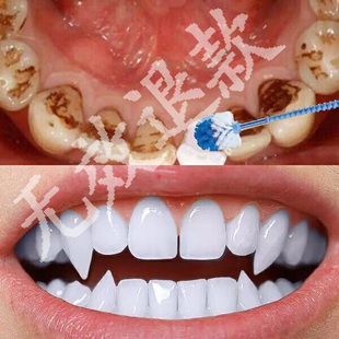 云南本草洗牙洁牙粉非美白牙齿洗白变白速傚去黄亮白去牙结石