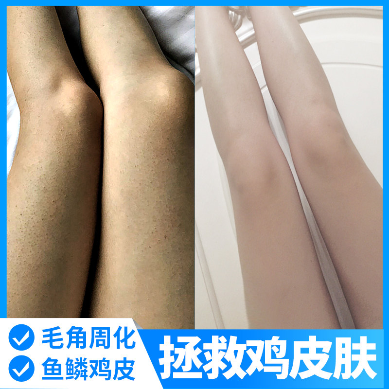 植肤秀去鸡皮毛囊角质精华液身体乳全身疙瘩大腿去除鱼鳞蛇皮嫩肤