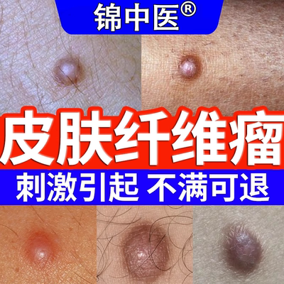 锦中医脂肪瘤硬疙瘩皮肤纤维瘤膏肿块消瘤膏囊肿硬块去除凝胶aw