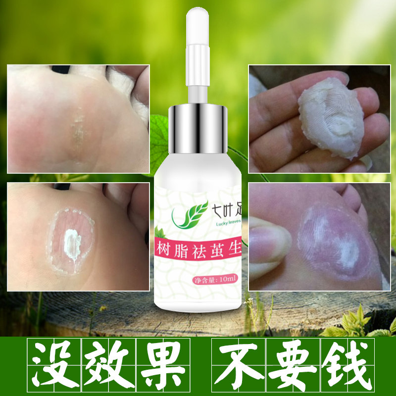 鸡眼贴脚底老茧膏去鸡眼药足手部肉刺丁去除跖疣正品旗舰店
