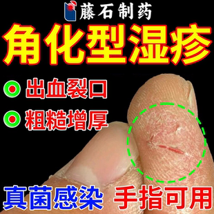 手指角化型湿疹手癣鹅掌风脱皮干裂真菌感染专外用膏药监备案VP