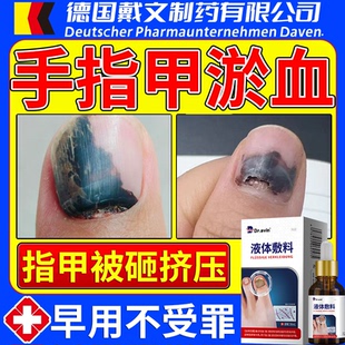 Dr.avin脚趾手指甲下有淤血淤青变黑被砸夹甲床受损液体敷料VP