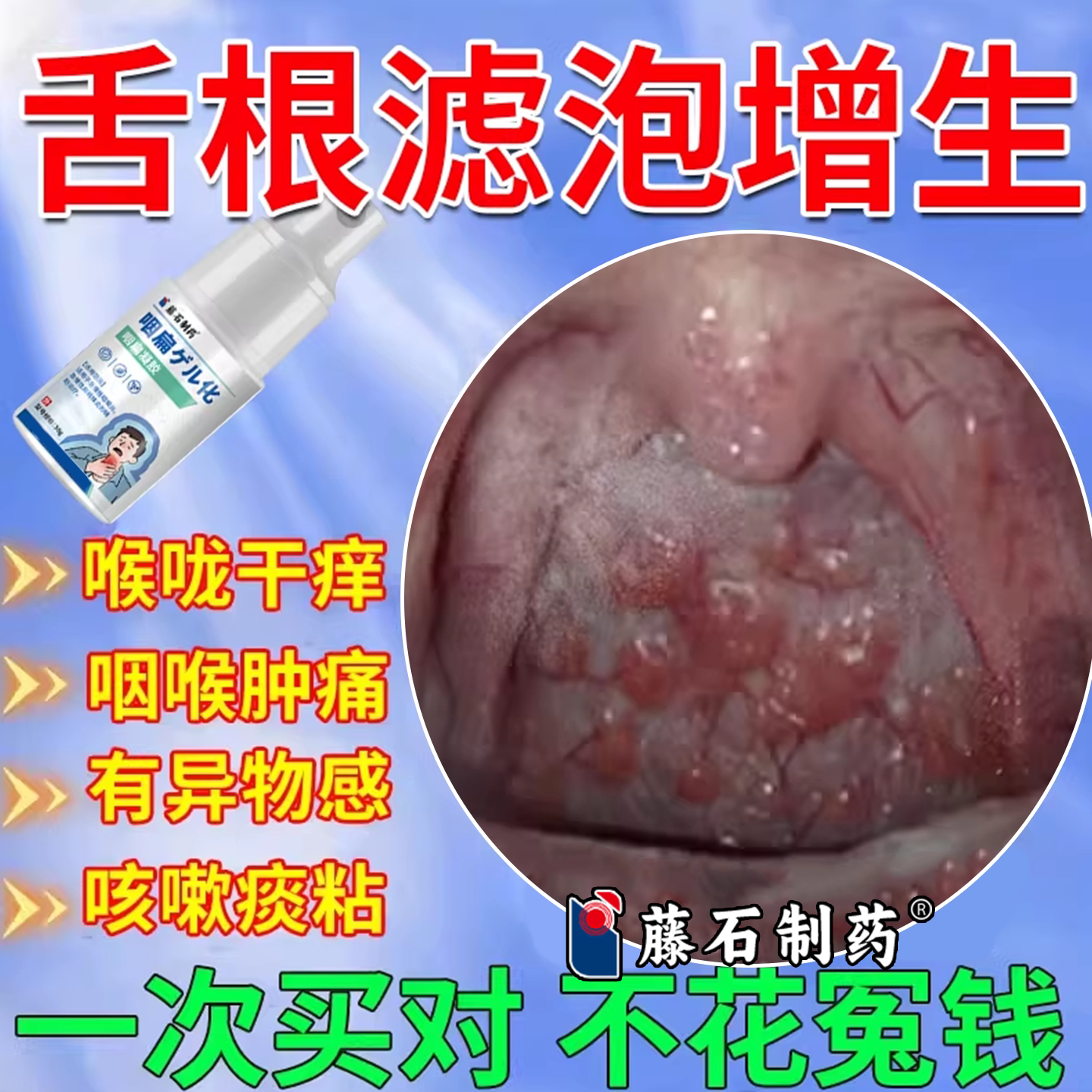 舌根长疙瘩咽喉炎慢性咽炎除有异物感根舌根咽后壁淋巴滤泡增生CA