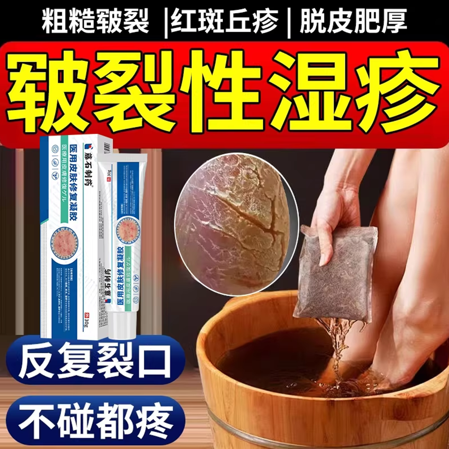 脚上水泡湿疹止痒去角化皲裂性湿疹泡脚药包皮肤止痒皮炎CA