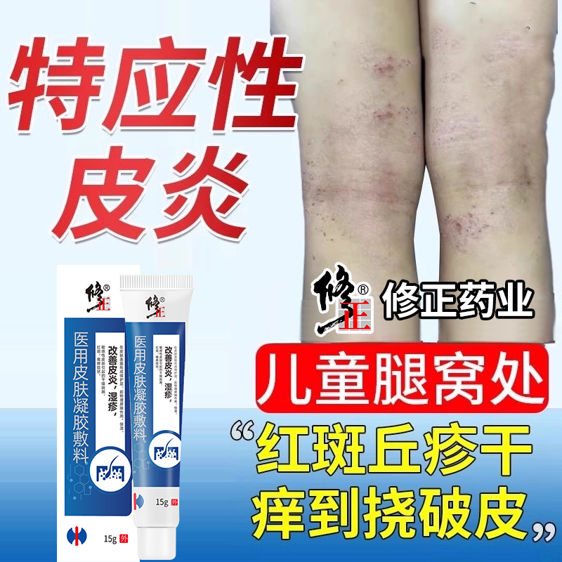 儿童特应性皮炎止痒身体乳