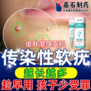 传染性软疣儿童水猴子点疣水医用祛疣瘊丝状疣扁平疣去小肉粒CA