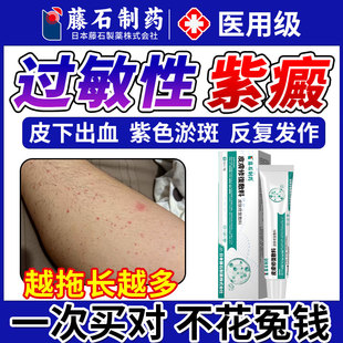 过敏性紫癜专用膏色素特皮下出血效红点瘀皮炎血管炎CA